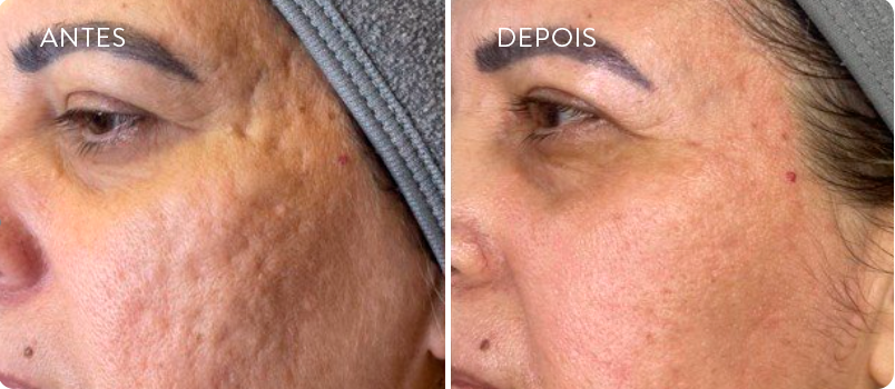 Resultados em 1 sessão